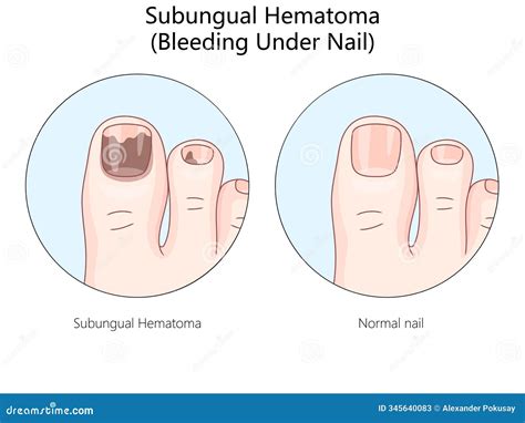 Diagram illustrating subungual hematoma, showing blood trapped under the toenail.