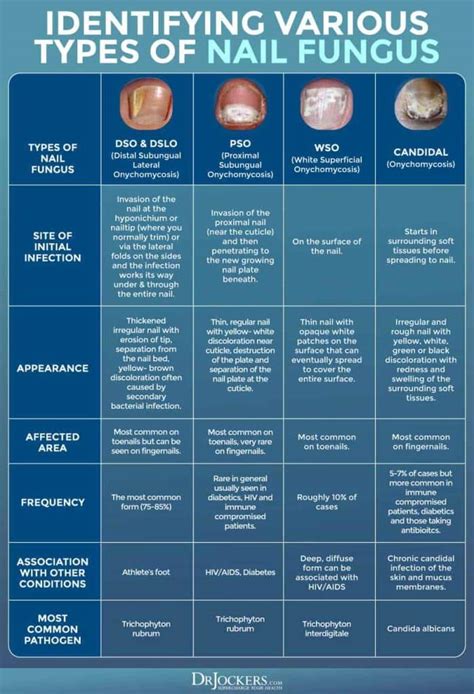 Infographic comparing the visual differences between toenail fungus, nail psoriasis, and nail trauma.