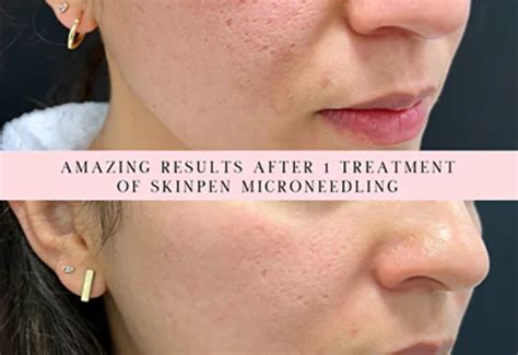 Image of a person with smooth, glowing skin, representing the results of microneedling