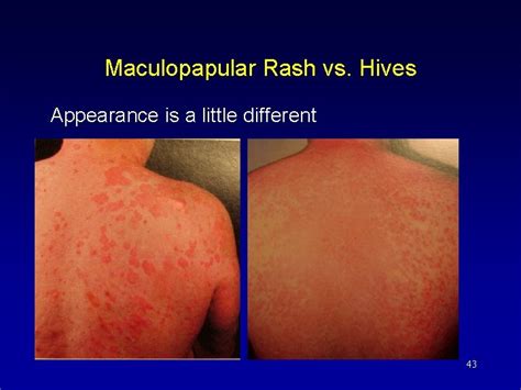 Illustration showing the difference between immediate hives and delayed maculopapular rash