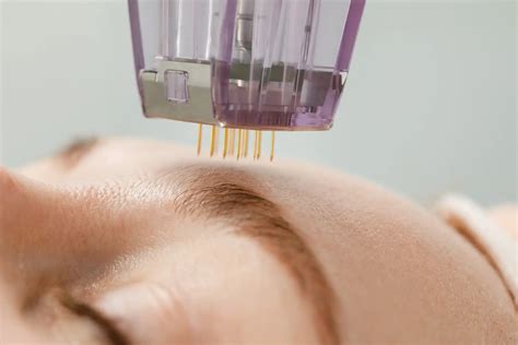 Close-up of skin after microneedling treatment