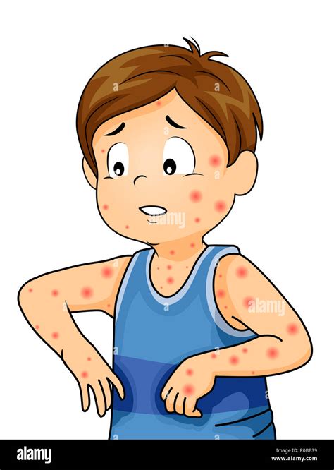 Illustration of the chickenpox rash on skin