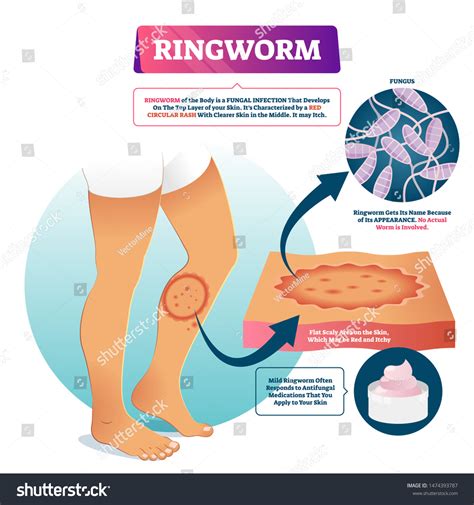 Diagram illustrating the spread of ringworm fungus through contaminated objects and direct contact.