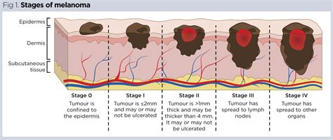 Diagram illustrating the different stages of melanoma, from Stage 0 to Stage IV, with visual representations of tumor thickness and spread.