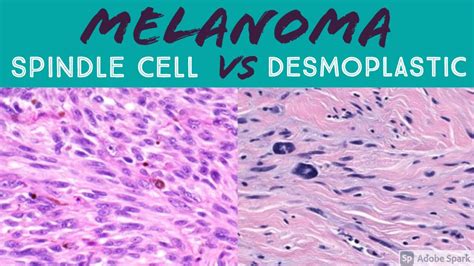 Schematic representation of spindle cell morphology in desmoplastic melanoma