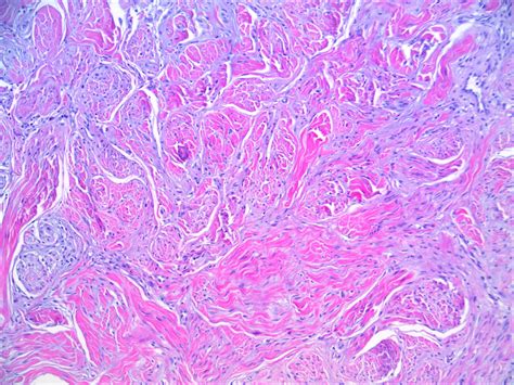 Histological image showing spindle cells within a dense fibrous stroma, characteristic of desmoplastic melanoma