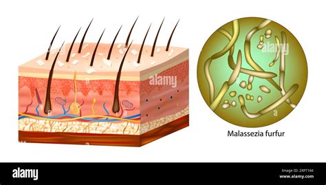 Illustration of Malassezia fungus on a scalp