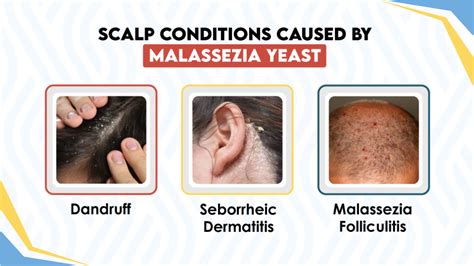 Diagram illustrating the cycle of Malassezia overgrowth leading to dandruff