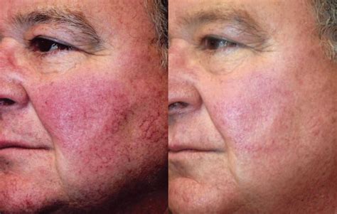 Before and after photos showing significant reduction in facial redness and visible blood vessels after IPL treatment for rosacea.