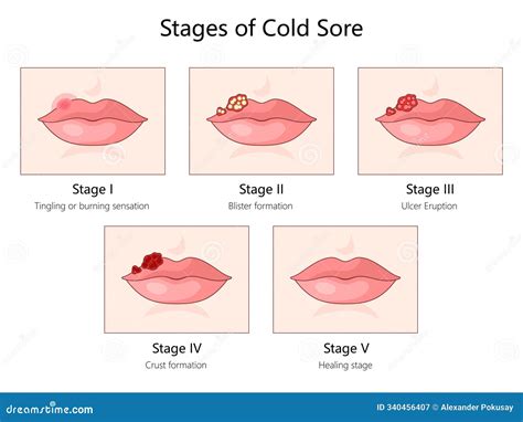 Illustration showing the stages of a cold sore outbreak, from tingling to scab formation and healing.