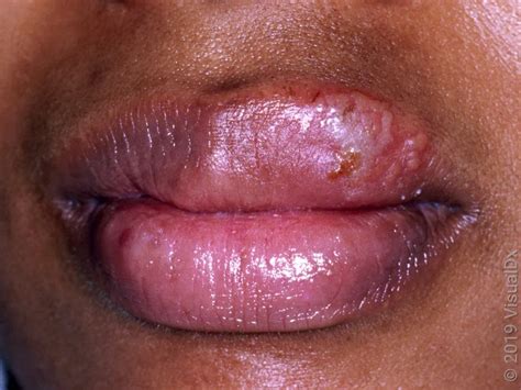 Close-up image of a cold sore blister on the lip.