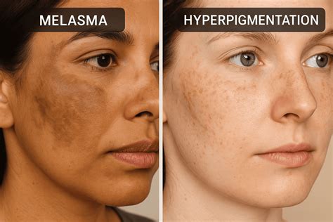 illustrations of sunspots, melasma, and post-inflammatory hyperpigmentation