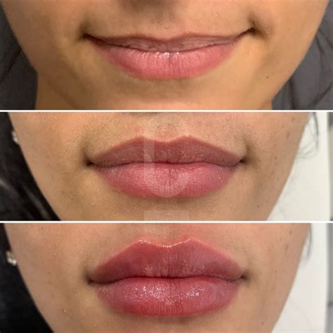 A collage of diverse lip shapes and sizes, showcasing natural to enhanced looks after lip filler treatments.