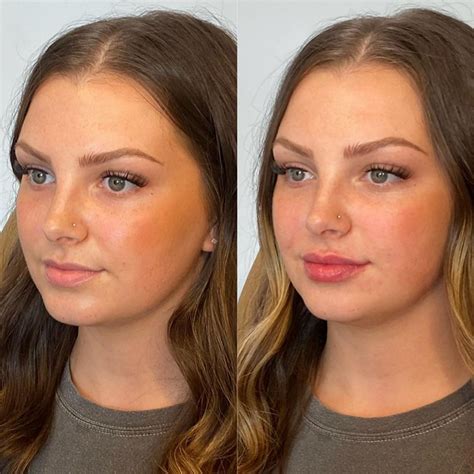 A split image showing lips before and after a subtle, natural lip filler enhancement.
