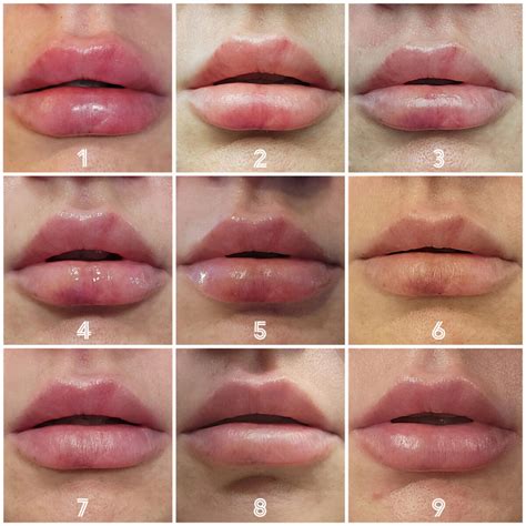 A timeline graphic illustrating the typical swelling and bruising progression after lip filler injections.