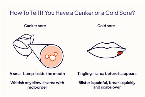 Infographic detailing the differences between cold sores, canker sores, and lip pimples.