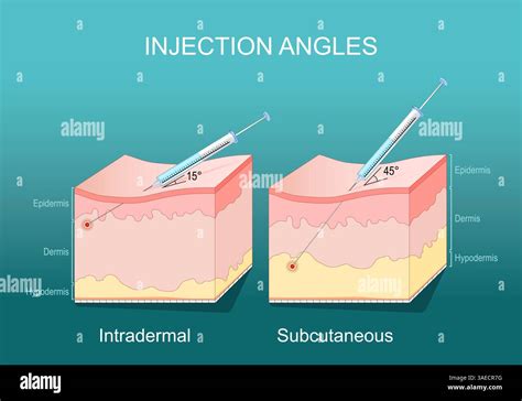 Anatomical illustration of facial layers showing subdermal injection sites for PLLA and HA.