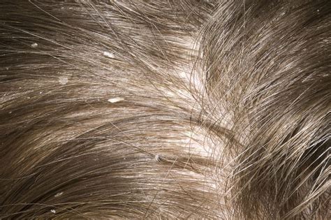Close-up image of a scalp with visible white and yellowish dandruff flakes on hair and skin.