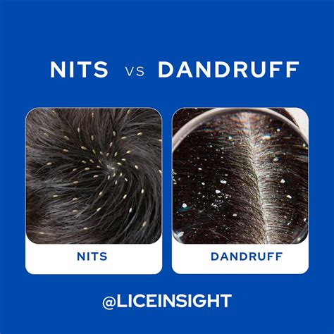 Side-by-side comparison graphic highlighting the visual differences between nits on hair and dandruff flakes.