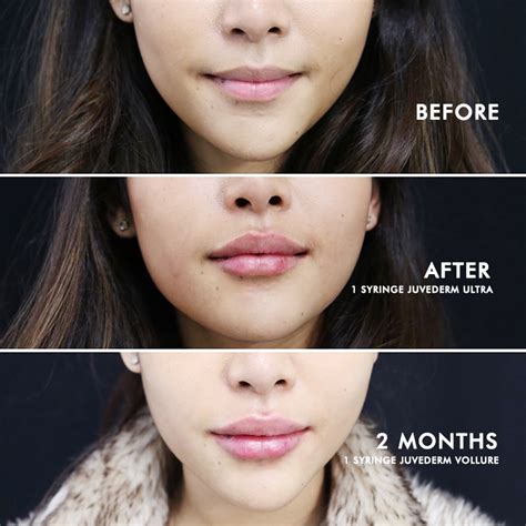 Before and after photos of lip augmentation results.