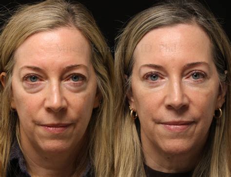 Before-and-after images of patients who have undergone facial rejuvenation procedures like facelifts and blepharoplasty.