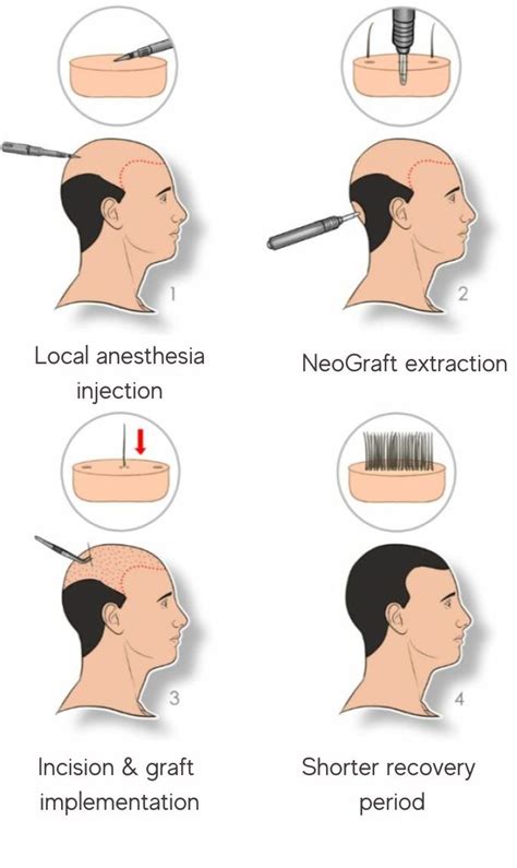 A comparison graphic illustrating the differences between TED Hair Restoration and NeoGraft Hair Transplant, detailing their mechanisms and outcomes.
