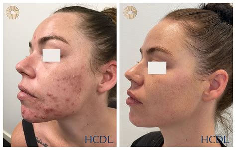 Before and after photos showcasing aesthetic dermatology results