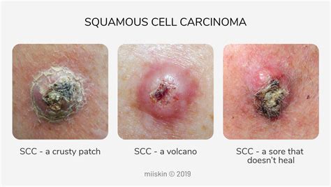 Close-up photograph of a patch of squamous cell carcinoma in situ on the skin
