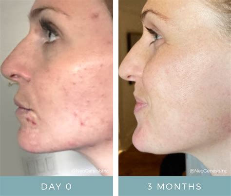 Split image: Left side shows skin with hormonal acne, right side shows clearer, hydrated skin after a modified HydraFacial