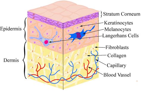 Diagram showing the layers of skin and how stretch marks form when the dermis layer tears.