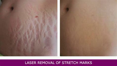 Illustration comparing different laser treatment methods for stretch marks.