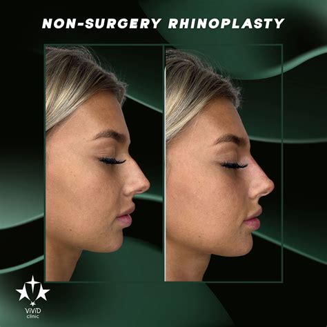 Illustration comparing the invasive nature of surgical rhinoplasty with the minimally invasive nature of injectable fillers.