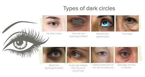 Illustration showing the layers of skin around the eye and common causes of dark circles.