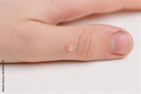 Close-up image of a common wart on a hand