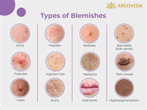 Illustration of a teenage face with various types of acne blemishes.