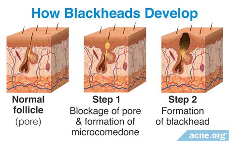 Diagram illustrating the formation of blackheads, whiteheads, and pimples within a hair follicle.