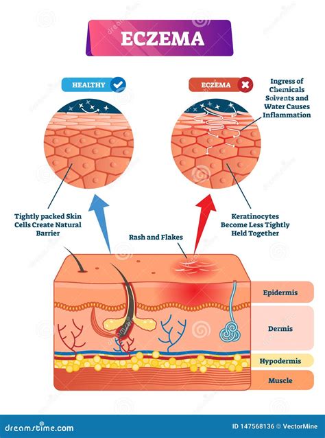 Diagram showing the layers of skin and how eczema affects the skin barrier.