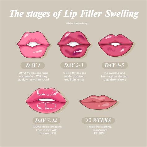 Illustration showing the process of lip filler injection and immediate post-procedure appearance.