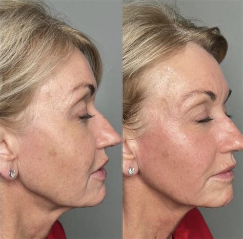 Before and after images of a patient who underwent radiofrequency skin tightening on their face, showing reduced wrinkles and improved firmness.