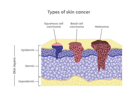 A diagram illustrating the different layers of the skin and where various types of skin cancer originate.