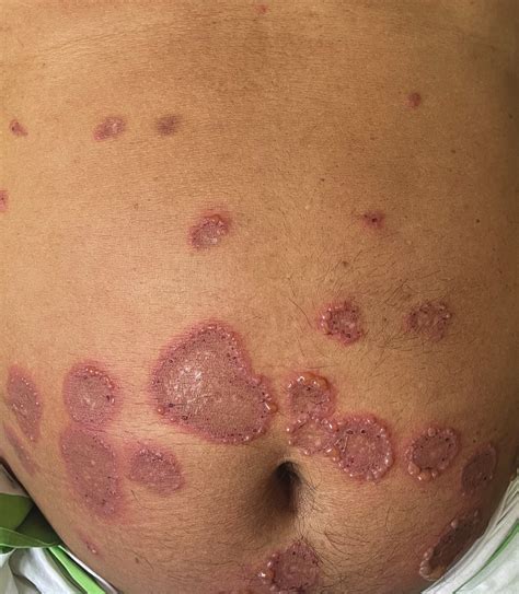 Illustration of the rash with vesicles, bullae, and erythematous plaques in a linear arrangement.