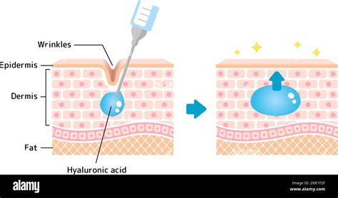 Infographic illustrating the mechanisms of action for retinol, peptides, and hyaluronic acid on skin structure.