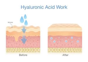 Diagram showing how hyaluronic acid molecules bind to water in the skin, increasing volume and reducing wrinkle depth.