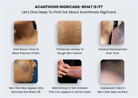 Illustration highlighting common body folds and creases affected by acanthosis nigricans.