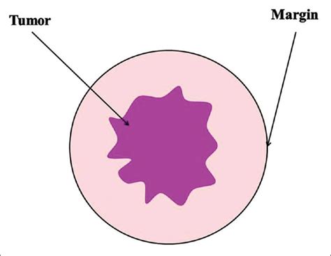 Surgical diagram showing the excision of an oral tumor with adequate margins, including potential bone resection.