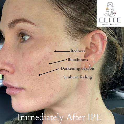 Close-up of skin showing darkened spots post-IPL treatment before flaking