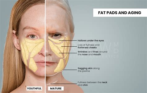 Diagram showing the layers of the cheek: bone, muscles, deep fat pads, superficial fat pads, and skin.