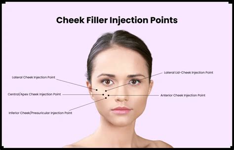 Illustration showing the key cheek filler injection points: Zygomatic Arch, Malar Eminence, Submalar Region, and Deep Medial Cheek Fat Pad.