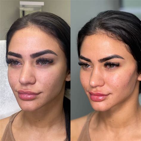 Comparison chart illustrating the properties of firm vs. flexible fillers and their ideal applications in cheek augmentation.