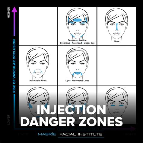 Visual guide demonstrating safe injection zones and potential vascular risks in the midface.